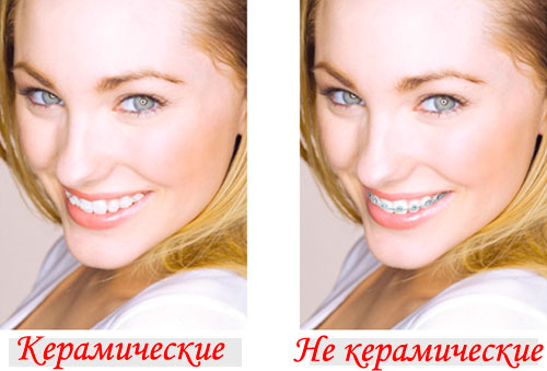 Керамические брекеты в москве